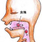 デンチャープラークと病気