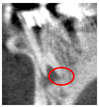 ②歯科用CTでもう一つ未治療の根の管があると判明した